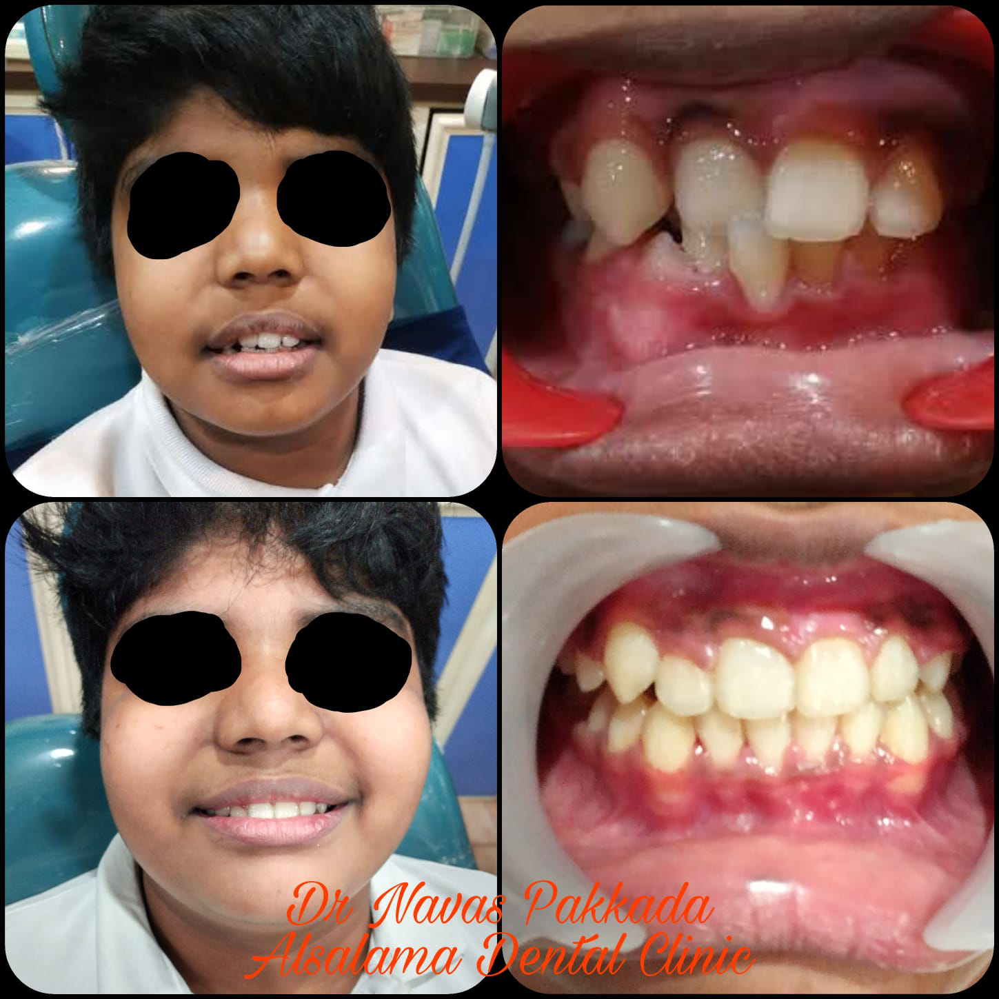 Anterior crossbite correction
